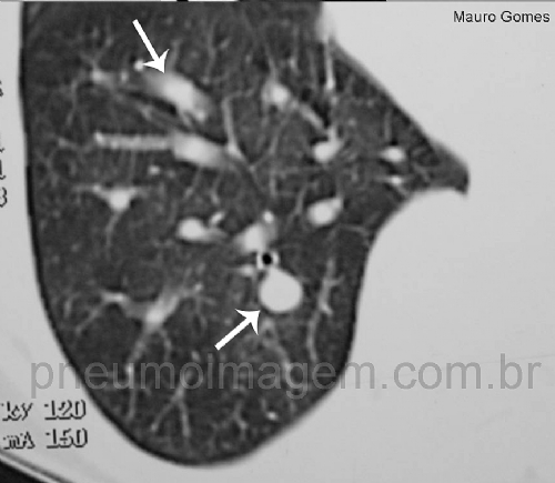 REVIS�O DA ERS SOBRE EMBOLIA PULMONAR CR�NICA: FA�A O DOWNLOAD